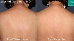 vbeam perfecta laser skin treatment