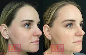 vbeam before after photos dr