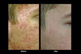 bellevue laser and cosmetic center acne