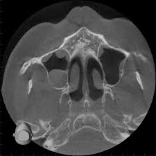 cone beam computed tomography in ent