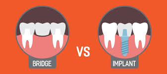 dental implants or bridge treatment
