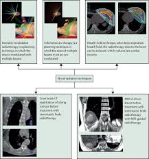 contemporary radiotherapy present and