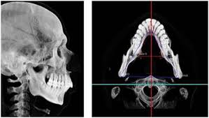 bruxism on craniomandibular morphology