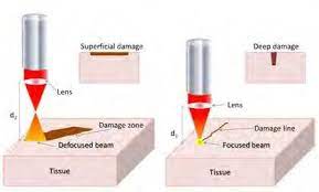 focusing and defocusing laser beam