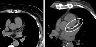 more support for cardiac ct s value