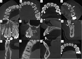 external cervical resorption