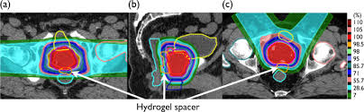 radiation therapy for prostate cancer