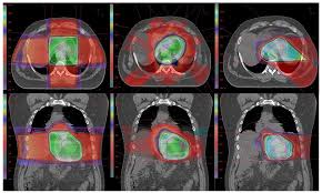 modulated radiation therapy