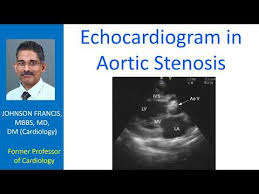 Echocardiogram In Aortic Stenosis All