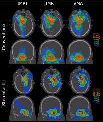 skull base meningiomas