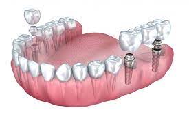 dental implant vs bridge cost dental