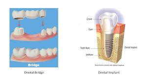 dental implant versus dental bridge