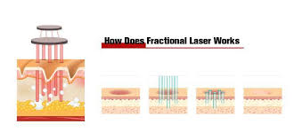 co2 cold fractional laser equipment