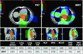 proton beam therapy