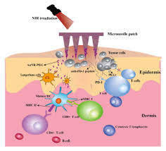 photothermal therapy and immunotherapy