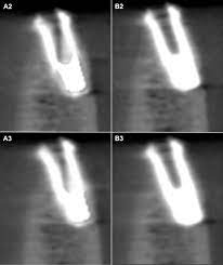 detection of peri implant fenestrations