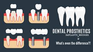 tooth implant vs bridge pros cons