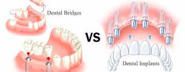 dentures vs dental bridge