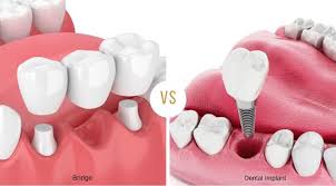 dental implant or bridge