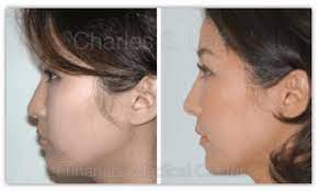 features with rhinoplasty