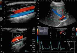 Doppler Ultrasound An Overview