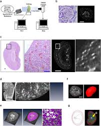 Impacts Of Diabetes And An Sglt2