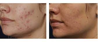 smoothbeam vbeam laser for acne