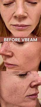 vbeam laser before and after natural kaos