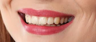 best midtown nyc zoom teeth whitening