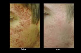bellevue laser and cosmetic center acne