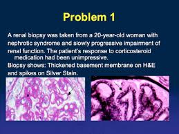 Renal Glomerular Disease Problem
