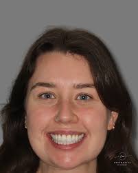 Smile transformation 🙌🏻🤩😁