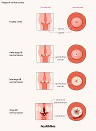 For cervical cancer, immunotherapy might be considered when the cancer is advanced and other treatments aren't working. Cervical Cancer Causes Symptoms Prevention And Treatment