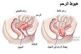 نزول الرحم و أسبابه و أعراضه و كيفية الوقاية منه و علاجه مجلة رقيقة