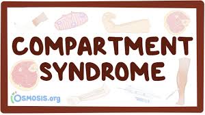Image result for Compartment Syndrome