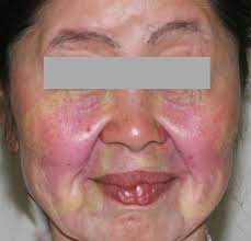 .plaques, lupus pernio, scar sarcoidosis, and subcutaneous sarcoidosis 5. Lupus Pernio Article