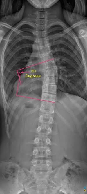 Cobb Angle Example | لماذا يعتبر الكشف المبكر عن اعوجاج العمود الفقري مهمًا أثناء النمو؟
