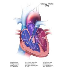 4 5 Tetralogy Of Fallot Cdc