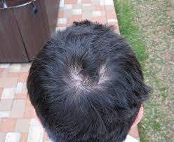 After 30 dutasteride forums in hairsite and endless speculation for almost two years, dutasteride is finally a reality under the brand name avodart™ ! My Experience With Dutasteride Hairlosstalk Forums