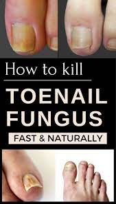 how to get rid of toenail fungus fast and naturally beautypro clubf zehennagelpilz nagelpilz hausmittel nagelpilz