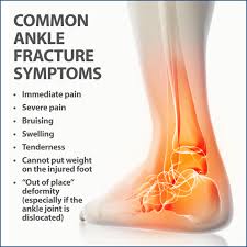 The medial malleolus is the largest of the three bone segments that form your ankle. Ankle Fractures Broken Ankle Florida Orthopaedic Institute