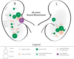 First In Human Clinical Trial Of Ultrasonic Propulsion Of Kidney Stones Sciencedirect