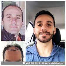 I Am Very Happy With My Hair Transplant Results Hair Loss Men Hair Transplant Results Hair Transplant