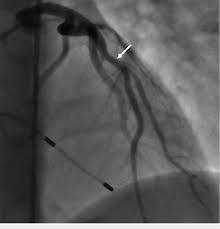 We did not find results for: Number Of Diagonal Arteries Arterial Supply Of The Heart Right And Left Coronary Artery For The Technique To Take Over The Function Of The Heart And Lungs Arterial Tree