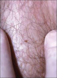 Image result for pubic lice symptoms