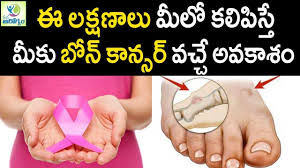 Osteosarcoma, chondrosarcoma, and ewing's sarcoma. Warning Signs Of Bone Cancer Mana Arogyam Telugu Health Tips Youtube