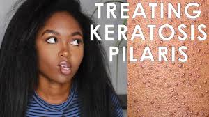 Application of hydrogen peroxide hydrogen peroxide can be very helpful of the removal of the skin condition. Treating Keratosis Pilaris 3 Easy Steps Youtube
