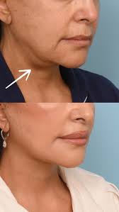 A transformation that speaks volumes without saying a word! ⭐️, This  patient had Dr. Balikian’s signature Artiste Lift, with the focus of  reducing her submandibular glands to sculpt her jawline. Her ...