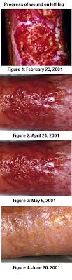 Wound Management Management Of Bilateral Leg Ulcers
