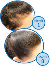 Treatments are given about once a month and help stimulates new hair growth. Systematic Review Confirms Which Hair Loss Treatments Work